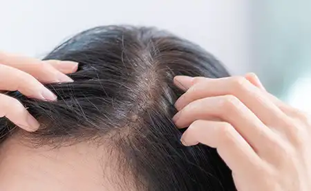 薄毛は確実に進行します
